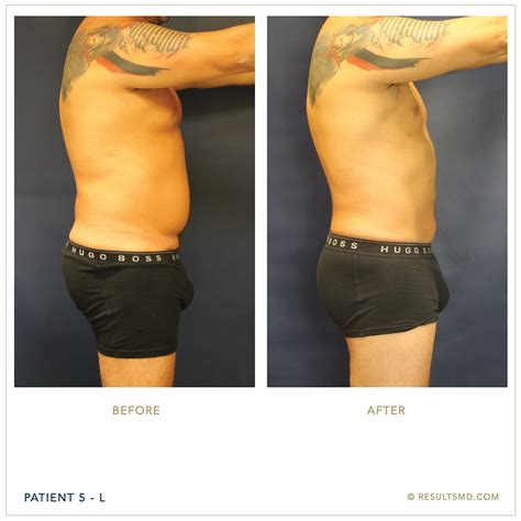 male liposuction miami|Miami male lipousction 